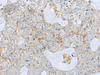 Immunohistochemistry of paraffin-embedded Human ovarian cancer tissue  using NAGK Polyclonal Antibody at dilution of 1:35(×200)