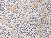Immunohistochemistry of paraffin-embedded Human breast cancer tissue  using GMPR Polyclonal Antibody at dilution of 1:60(×200)
