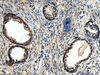 Immunohistochemistry of paraffin-embedded Human prost ate cancer tissue  using ERLIN1 Polyclonal Antibody at dilution of 1:50(×200)