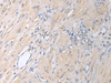 Immunohistochemistry of paraffin-embedded Human gastric cancer tissue  using GNAI1 Polyclonal Antibody at dilution of 1:130(×200)