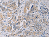 Immunohistochemistry of paraffin-embedded Human esophagus cancer tissue  using CYTIP Polyclonal Antibody at dilution of 1:50(×200)