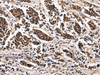 Immunohistochemistry of paraffin-embedded Human breast cancer tissue  using ARPC1B Polyclonal Antibody at dilution of 1:65(×200)