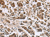 Immunohistochemistry of paraffin-embedded Human breast cancer tissue  using SIK3 Polyclonal Antibody at dilution of 1:60(×200)