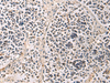 Immunohistochemistry of paraffin-embedded Human breast cancer tissue  using PAIP1 Polyclonal Antibody at dilution of 1:80(×200)