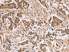 Immunohistochemistry of paraffin-embedded Human breast cancer tissue  using DNA2 Polyclonal Antibody at dilution of 1:40(×200)