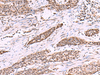 Immunohistochemistry of paraffin-embedded Human esophagus cancer tissue  using CUL4A Polyclonal Antibody at dilution of 1:55(×200)