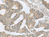 Immunohistochemistry of paraffin-embedded Human colorectal cancer tissue  using CXCR5 Polyclonal Antibody at dilution of 1:80(×200)