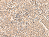 Immunohistochemistry of paraffin-embedded Human cervical cancer tissue  using CCNE1 Polyclonal Antibody at dilution of 1:25(×200)