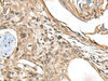 Immunohistochemistry of paraffin-embedded Human esophagus cancer tissue  using MAPK4 Polyclonal Antibody at dilution of 1:35(×200)