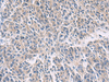 Immunohistochemistry of paraffin-embedded Human colorectal cancer tissue  using PROKR2 Polyclonal Antibody at dilution of 1:40(×200)