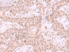 Immunohistochemistry of paraffin-embedded Human ovarian cancer tissue  using MCMBP Polyclonal Antibody at dilution of 1:35(×200)