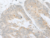 Immunohistochemistry of paraffin-embedded Human colorectal cancer tissue  using MLNR Polyclonal Antibody at dilution of 1:35(×200)
