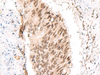Immunohistochemistry of paraffin-embedded Human colorectal cancer tissue  using CKMT1A/CKMT1B Polyclonal Antibody at dilution of 1:55(×200)