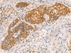 Immunohistochemistry of paraffin-embedded Human esophagus cancer tissue  using SREBF2 Polyclonal Antibody at dilution of 1:50(×200)
