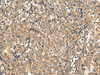 Immunohistochemistry of paraffin-embedded Human lung cancer tissue  using HNF1A Polyclonal Antibody at dilution of 1:50(×200)