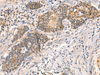 Immunohistochemistry of paraffin-embedded Human esophagus cancer tissue  using HNF1A Polyclonal Antibody at dilution of 1:50(×200)