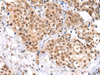 Immunohistochemistry of paraffin-embedded Human breast cancer tissue  using KEAP1 Polyclonal Antibody at dilution of 1:35(×200)