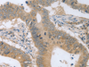 Immunohistochemistry of paraffin-embedded Human colon cancer tissue  using P2RY11 Polyclonal Antibody at dilution of 1:30(×200)