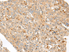 Immunohistochemistry of paraffin-embedded Human cervical cancer tissue  using SLC5A1 Polyclonal Antibody at dilution of 1:80(×200)