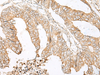 Immunohistochemistry of paraffin-embedded Human colorectal cancer tissue  using SLC5A1 Polyclonal Antibody at dilution of 1:80(×200)
