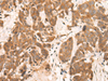 Immunohistochemistry of paraffin-embedded Human thyroid cancer tissue  using NRG2 Polyclonal Antibody at dilution of 1:65(×200)
