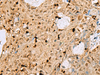 Immunohistochemistry of paraffin-embedded Human ovarian cancer tissue  using MAF Polyclonal Antibody at dilution of 1:25(×200)