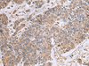 Immunohistochemistry of paraffin-embedded Human colorectal cancer tissue  using UBTD1 Polyclonal Antibody at dilution of 1:25(×200)