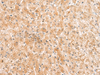 Immunohistochemistry of paraffin-embedded Human liver cancer tissue  using ZNF185 Polyclonal Antibody at dilution of 1:25(×200)
