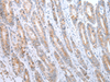 Immunohistochemistry of paraffin-embedded Human gastric cancer tissue  using ATG16L1 Polyclonal Antibody at dilution of 1:40(×200)