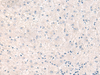 Immunohistochemistry of paraffin-embedded Human liver cancer tissue  using CEBPB  Polyclonal Antibody at dilution of 1:30(×200)