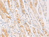 Immunohistochemistry of paraffin-embedded Human gastric cancer tissue  using CEBPB  Polyclonal Antibody at dilution of 1:30(×200)