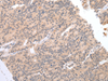 Immunohistochemistry of paraffin-embedded Human prost at e cancer tissue  using DEFB112 Polyclonal Antibody at dilution of 1:40(×200)