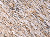 Immunohistochemistry of paraffin-embedded Human colorectal cancer tissue  using ECM1 Polyclonal Antibody at dilution of 1:25(×200)