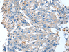 Immunohistochemistry of paraffin-embedded Human colorectal cancer tissue  using DCX Polyclonal Antibody at dilution of 1:35(×200)