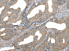 Immunohistochemistry of paraffin-embedded Human colorectal cancer tissue  using DDC Polyclonal Antibody at dilution of 1:30(×200)