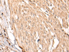 Immunohistochemistry of paraffin-embedded Human cervical cancer tissue  using HSF4  Polyclonal Antibody at dilution of 1:55(×200)
