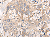 Immunohistochemistry of paraffin-embedded Human lung cancer tissue  using NREP Polyclonal Antibody at dilution of 1:35(×200)
