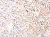 Immunohistochemistry of paraffin-embedded Human prost ate cancer tissue  using NREP Polyclonal Antibody at dilution of 1:35(×200)
