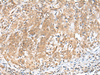 Immunohistochemistry of paraffin-embedded Human cervical cancer tissue  using PEG3 Polyclonal Antibody at dilution of 1:45(×200)