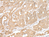 Immunohistochemistry of paraffin-embedded Human gastric cancer tissue  using SMARCA1 Polyclonal Antibody at dilution of 1:30(×200)