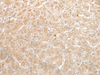 Immunohistochemistry of paraffin-embedded Human liver cancer tissue  using NUDT19 Polyclonal Antibody at dilution of 1:25(×200)