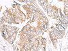Immunohistochemistry of paraffin-embedded Human colorectal cancer tissue  using GPC2 Polyclonal Antibody at dilution of 1:40(×200)