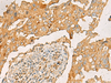 Immunohistochemistry of paraffin-embedded Human breast cancer tissue  using CXCL1 Polyclonal Antibody at dilution of 1:35(×200)