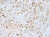 Immunohistochemistry of paraffin-embedded Human gastric cancer tissue  using HOXC9 Polyclonal Antibody at dilution of 1:40(×200)