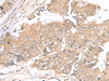 Immunohistochemistry of paraffin-embedded Human colorectal cancer tissue  using ARF5 Polyclonal Antibody at dilution of 1:40(×200)