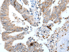 Immunohistochemistry of paraffin-embedded Human colorectal cancer tissue  using GKN1 Polyclonal Antibody at dilution of 1:30(×200)