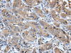 Immunohistochemistry of paraffin-embedded Human breast cancer tissue  using CXCL5 Polyclonal Antibody at dilution of 1:45(×200)