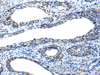 Immunohistochemistry of paraffin-embedded Human cervical cancer tissue  using IRF5 Polyclonal Antibody at dilution of 1:25(×200)