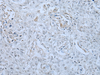 Immunohistochemistry of paraffin-embedded Human lung cancer tissue  using HUWE1 Polyclonal Antibody at dilution of 1:30(×200)