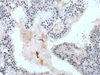Immunohistochemistry of paraffin-embedded Human breast cancer tissue  using ZBTB3 Polyclonal Antibody at dilution of 1:55(×200)